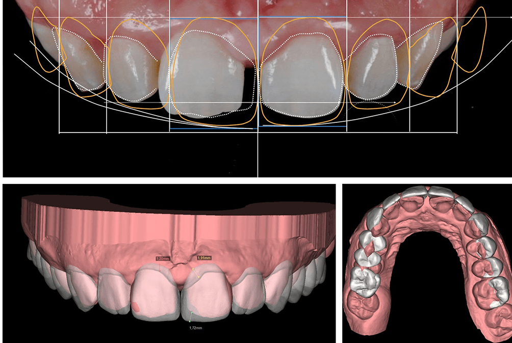 DSD (Digital Smile Design)